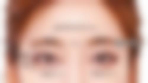 双眼皮手术后护理重要吗？和选择手术方式、医院有关系吗？