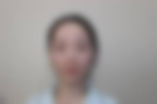 北京艺星医疗美容医院微创重脸术能带来怎样的成效呢？