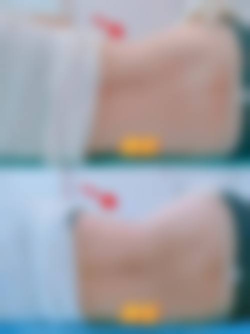 北京纯脂医疗美容腰腹吸脂，手术过程是怎样的？