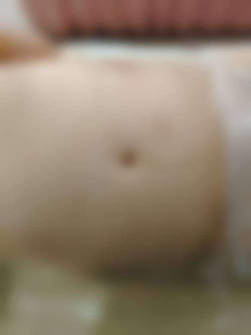 北京纯脂医疗美容腰腹吸脂体验：轻松甩掉赘肉，重塑平坦小腹，过程安心效果棒