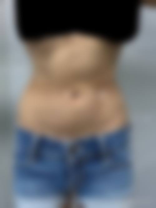 北京纯脂医疗美容腰腹吸脂，医生如何选择？