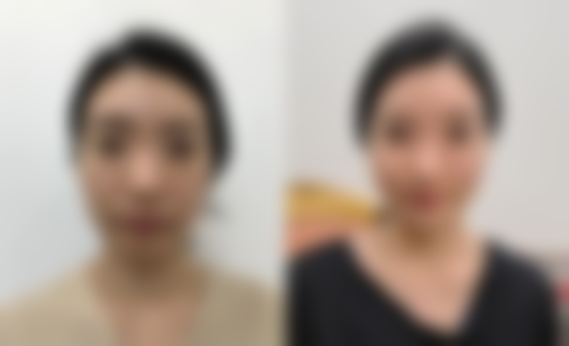 有双眼皮需求，为什么要尽快去正规医院医疗美容科就诊呢？