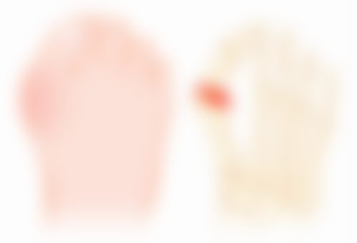 血肿与出血是怎么产生的，又该怎么处理？