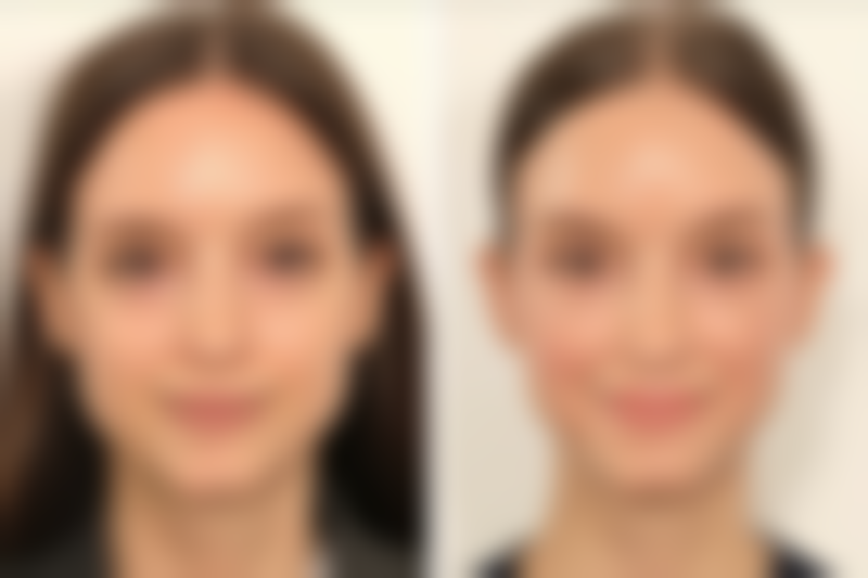 问题五：除了上述方法，还有哪些常见的去除脸上伤疤痕的方法？