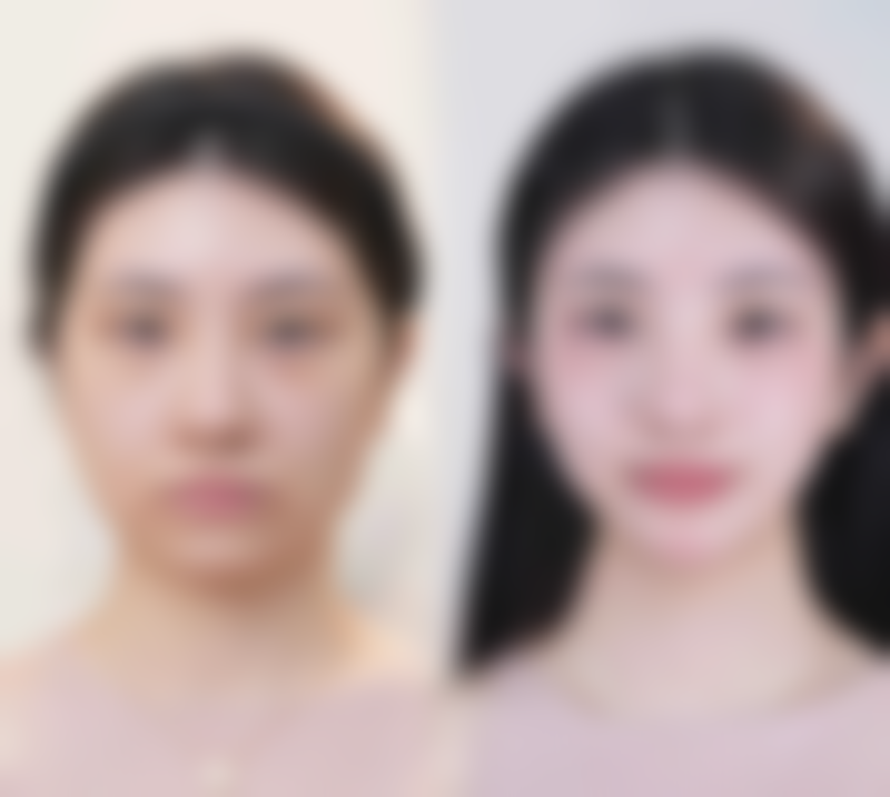 祛眼袋可以用医保吗？了解医保覆盖范围，轻松解决眼袋烦恼！祛眼袋医保报销有啥条件？ 