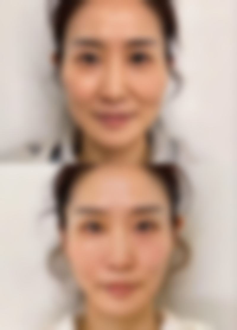 300cc通常能到C或D罩杯吗？