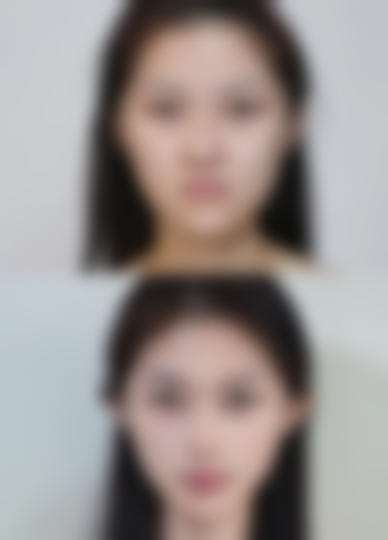 怀孕能割双眼皮吗? 专家解读安全性与注意事项！答案是不建议，孕期手术有健康风险！ 