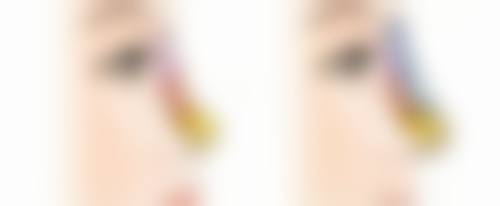 治疗增生的疤痕疙瘩在饮食与作息方面要怎么做？