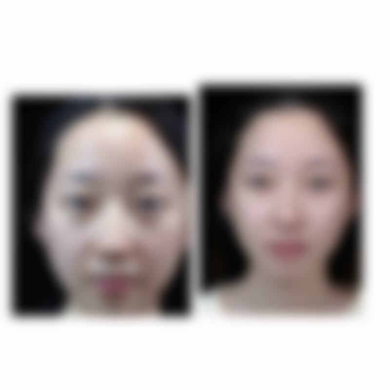 内双做双眼皮宽度设计有什么讲究呢？