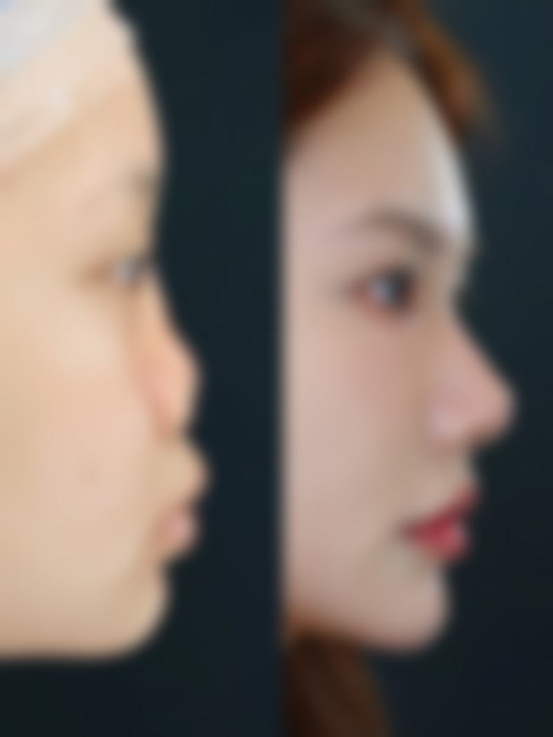 增生的疤痕疙瘩日常护理要注意什么？