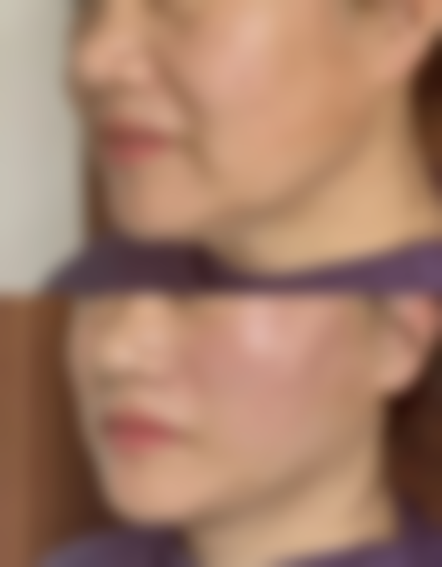 贝诺童儿童疤痕修护霜适合哪种疤痕？