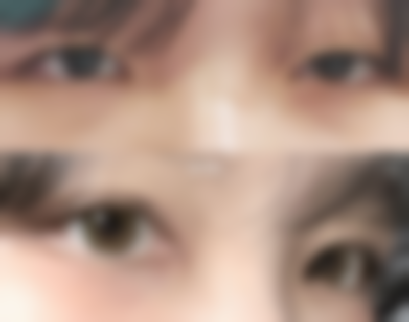 物理治疗减少疤痕增生的原理是什么，适合哪些疤痕？