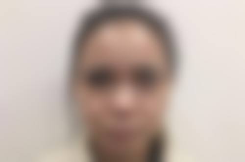 怎么样消除黑眼圈黑眼袋？医美方案之针对性治疗