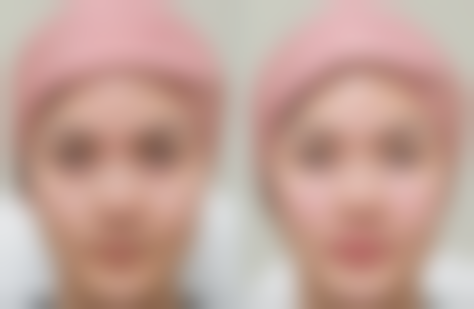 怎么样看自己是不是疤痕体质？这5个简单方法帮你轻松判断！疤痕体质能改善吗？ 