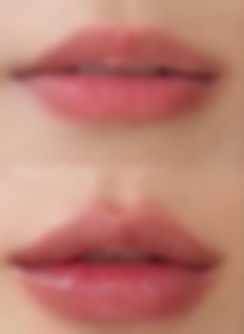 影响埋线双眼皮眼白充血修复的因素有哪些？