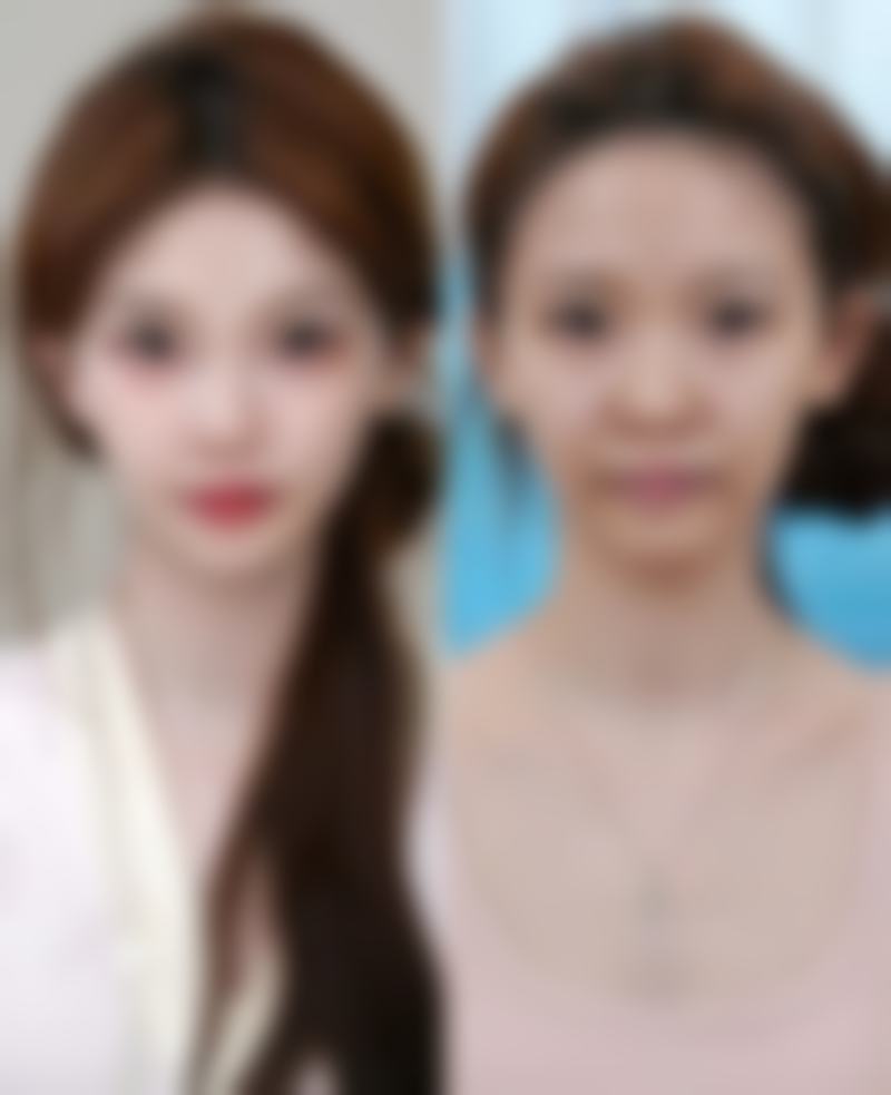 做去眼袋内吸手术要注意些什么？