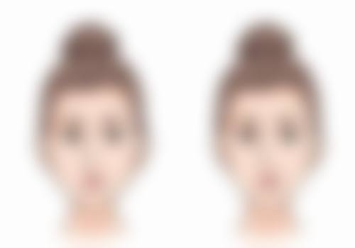 膨体假体的优缺点有哪些？适合什么人群？