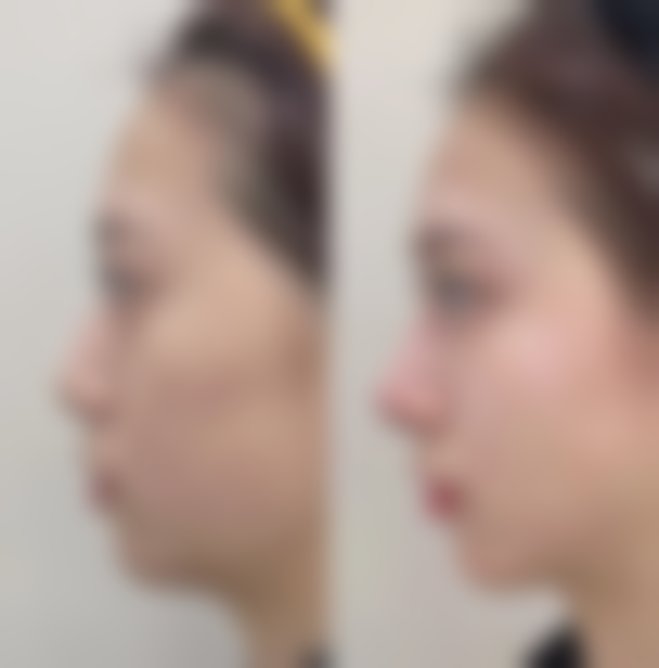 药物治疗对二十多年的陈旧性疤痕有成效吗？