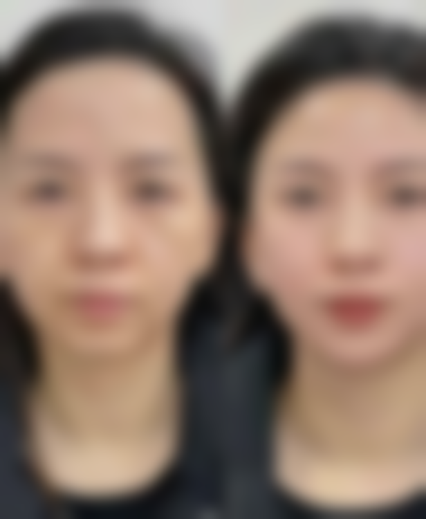 治疗二十多年的疤痕后需要注意什么呢？