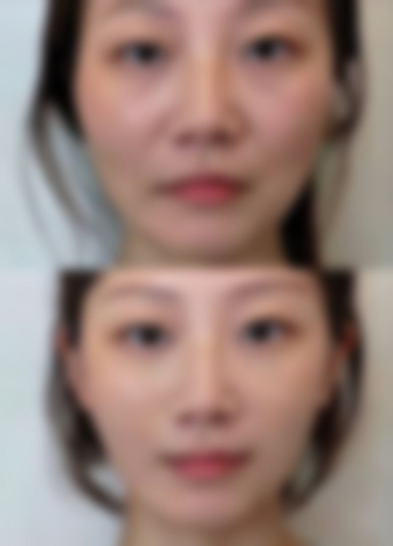 为了达到恒久缩水的成效，注射间隔是怎样的？