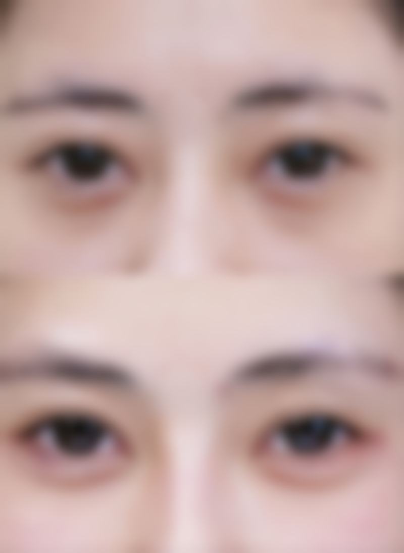 瘦脸针的注射方式是固定的“一边一针”吗？