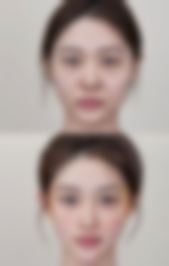 自体隆鼻要恢复多久？专家解读恢复期的真实情况与注意事项！恢复时间受哪些因素影响？ 