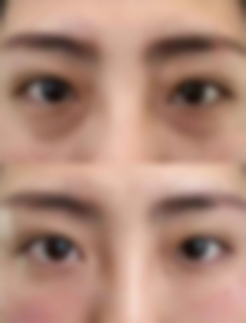 自体软骨隆鼻术后护理有哪些特别注意的呢？