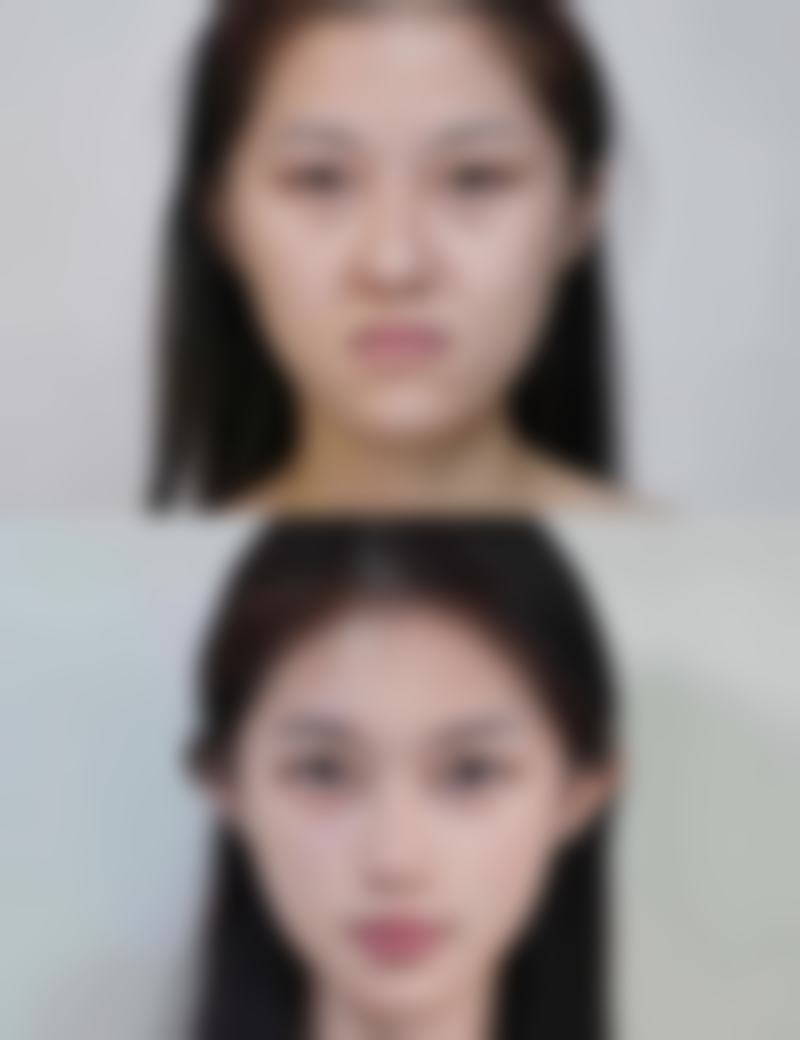 方法三：手术治疗大眼袋有哪些方式？各有什么优缺点呢？