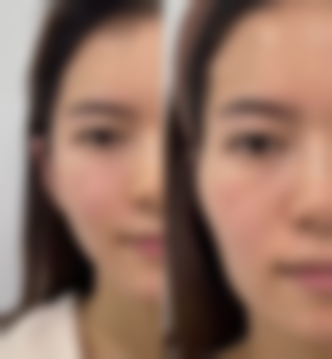 抽脂手术后护理方面有哪些注意事项呢？