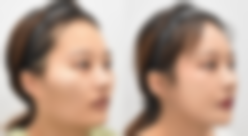 那什么时候是割双眼皮的至佳手术窗口期呢？