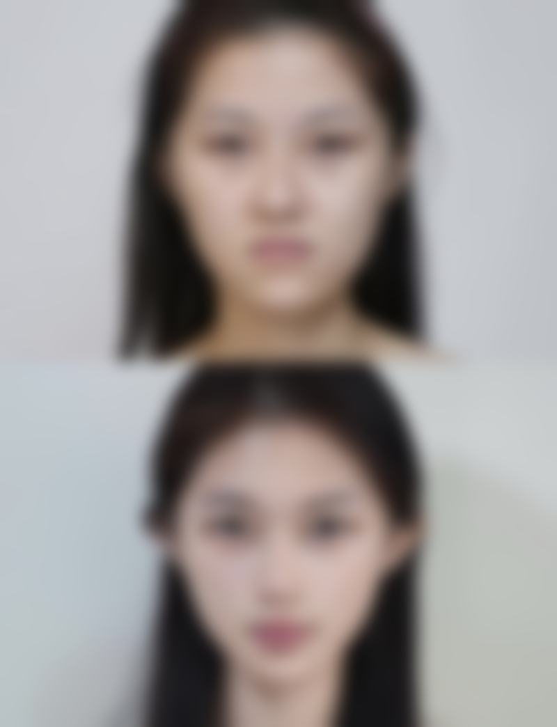 割双眼皮术后通用的修复时间范围是怎样的呢？