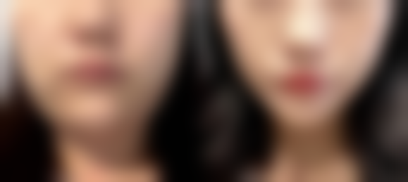 上海德琳医疗美容医院相俊增粗项目的术后注意事项有哪些？