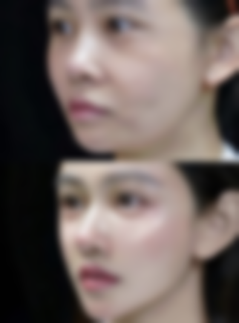 进行埋线手术前需要做哪些准备？