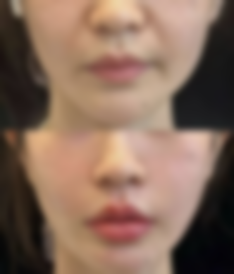 不同手术方式的修复时间有什么差异呢？