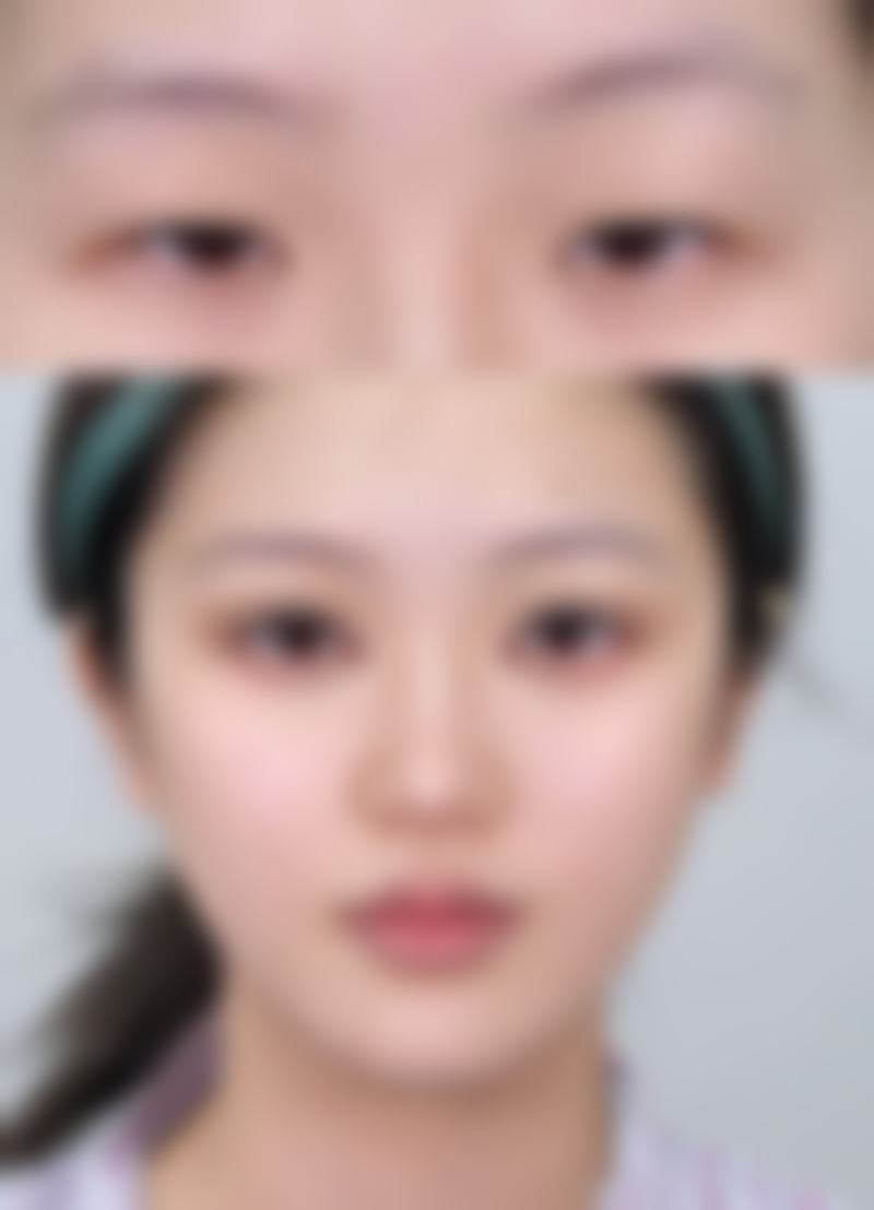 不开刀去眼袋对不同程度的眼袋成效一样吗？