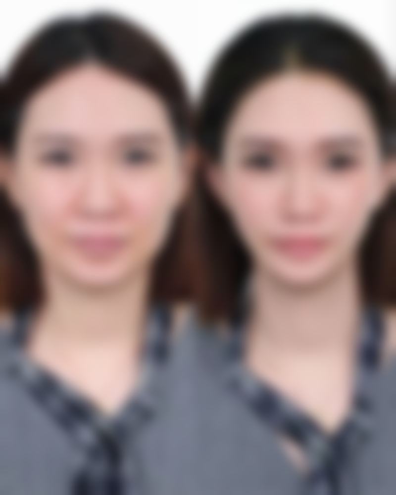 割双眼皮要多长时间？揭秘手术前后恢复的真实时间表！手术方式不同时间差异大吗？ 