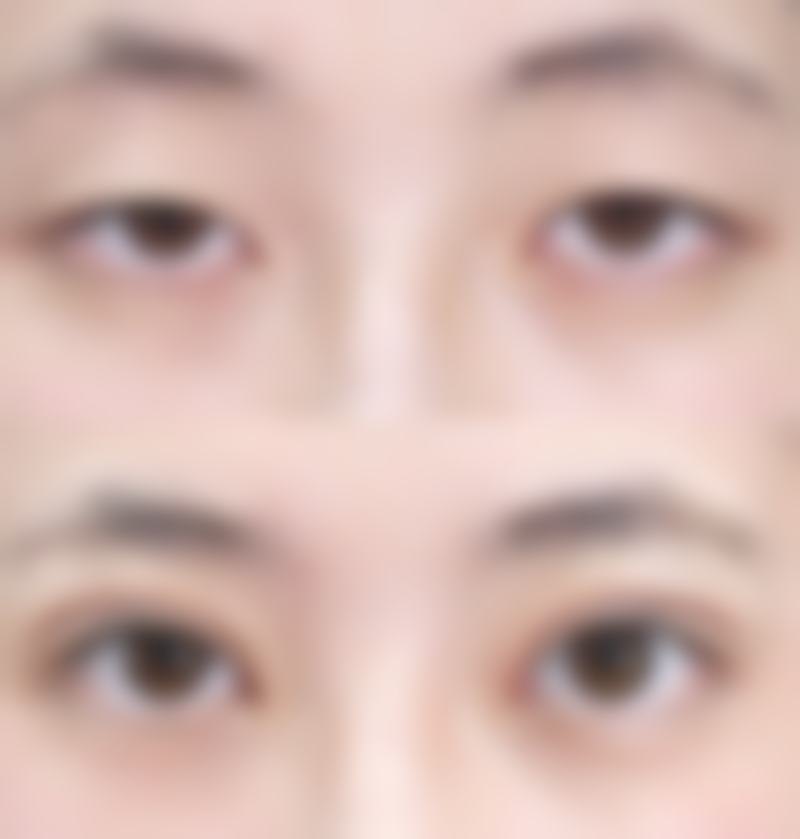 上海华美医疗美容医院的不开刀去眼袋成效如何？