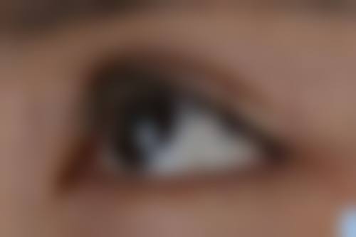 不同患者做去眼袋手术有怎样的真实体验呢？