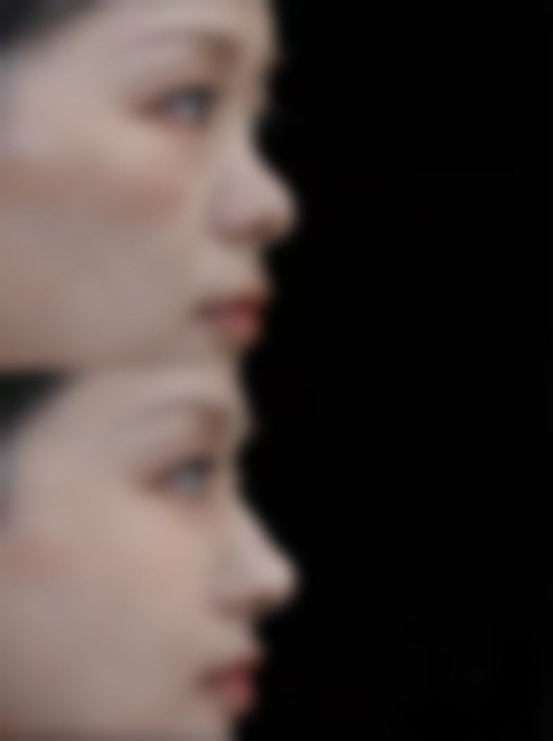 四川成都美容整形医院私密科邓娟娟：手术实例见真章