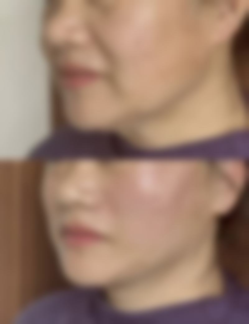 医美干预中的轻医美方法能解决眼部皱纹和眼袋问题吗？