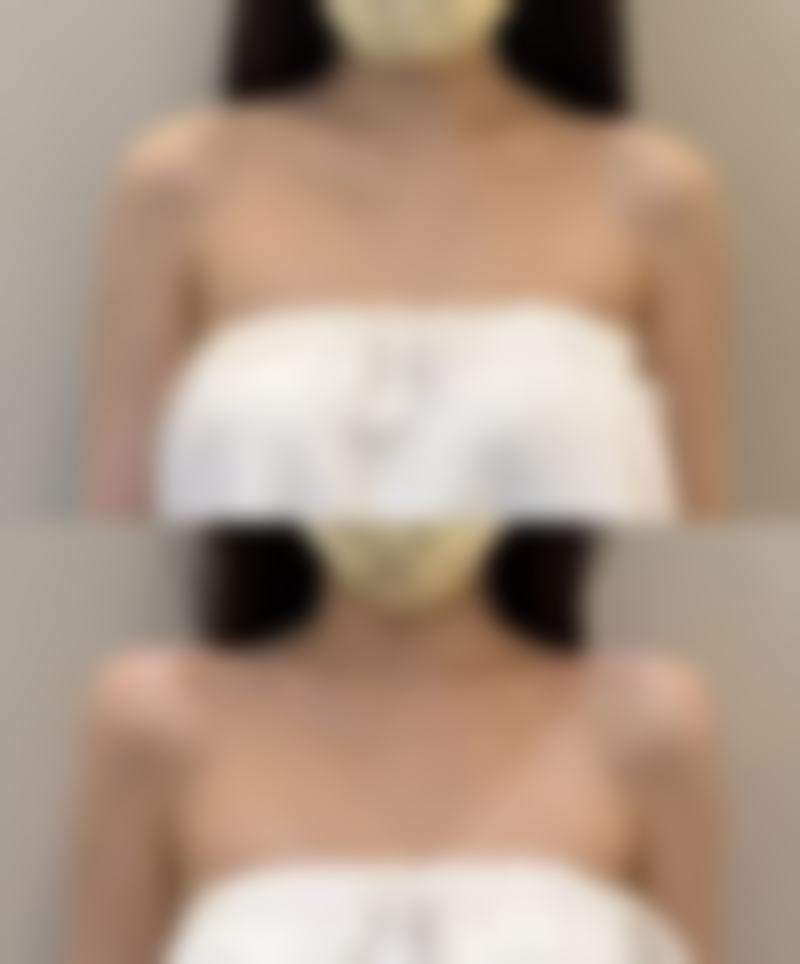 填充类方法去除眼袋上皱纹有啥优势和不足？