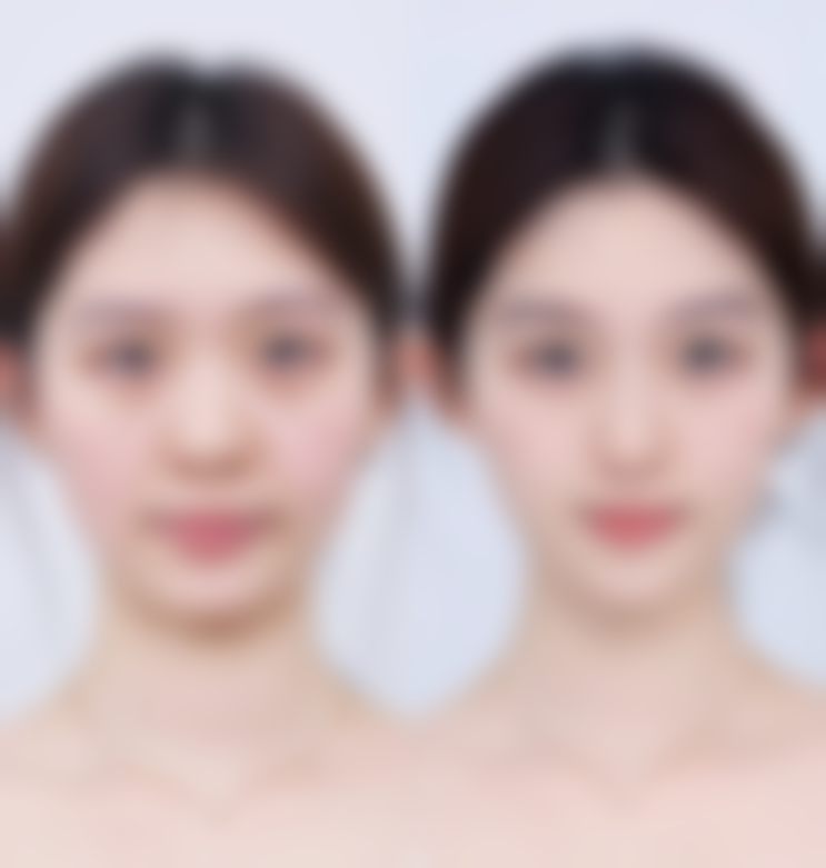 哪些因素会影响男人割双眼皮的手术成效（是否好看）呢？