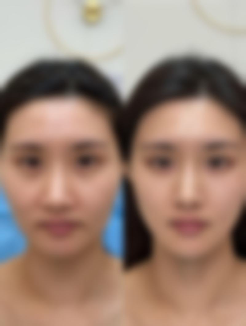 双眼皮手术后肿胀期吃什么比较合适？