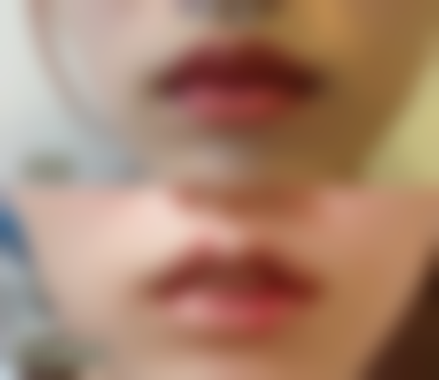 疤痕修复需要多长时间呢？