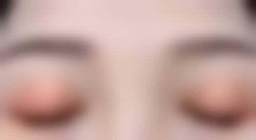 伤口护理:伤口怎么护理才能避免肿胀加重?