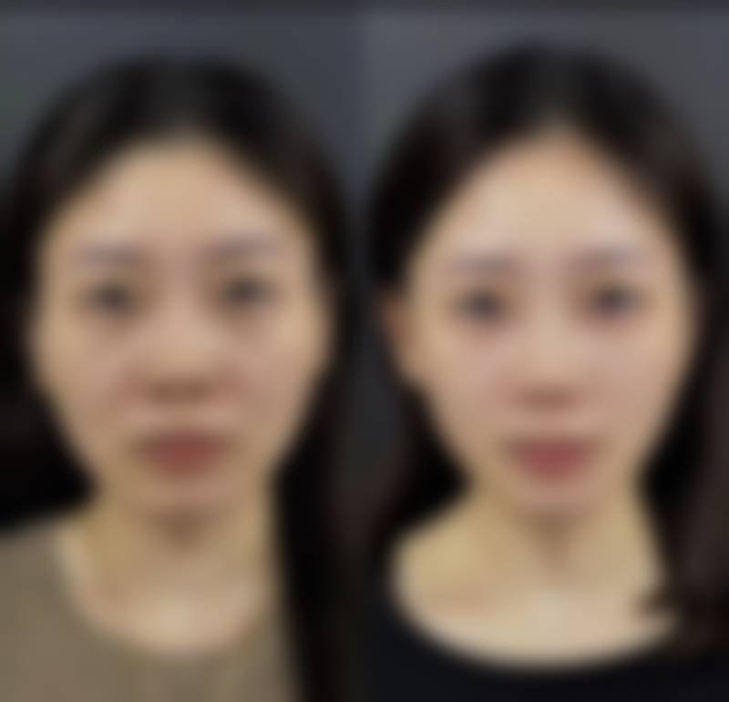 整双眼皮会留疤吗？揭开术后护理与效果的真相！怎样护理能让双眼皮效果更好不留疤？ 