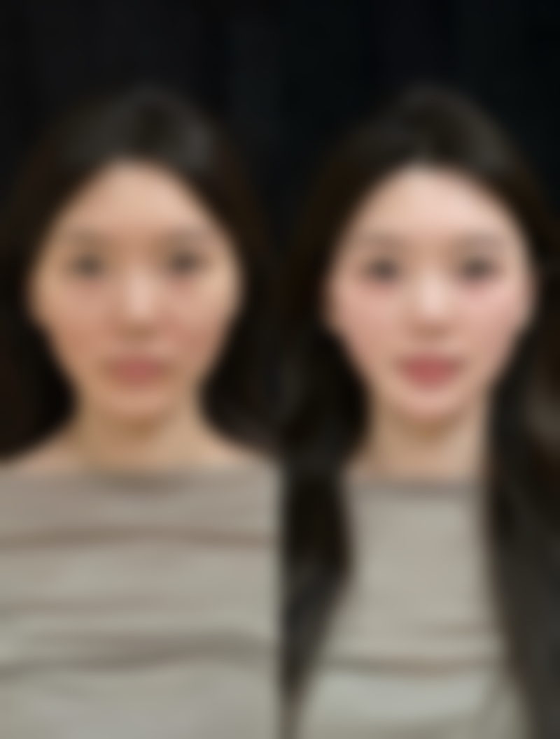 埋线双眼皮手术有什么特点,适合哪些人?