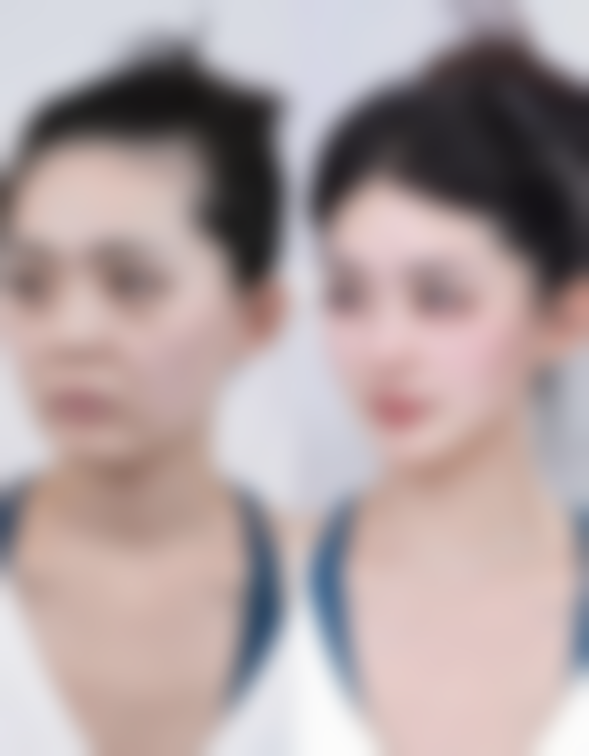 保妥适(Botox)有什么特点和适用人群?