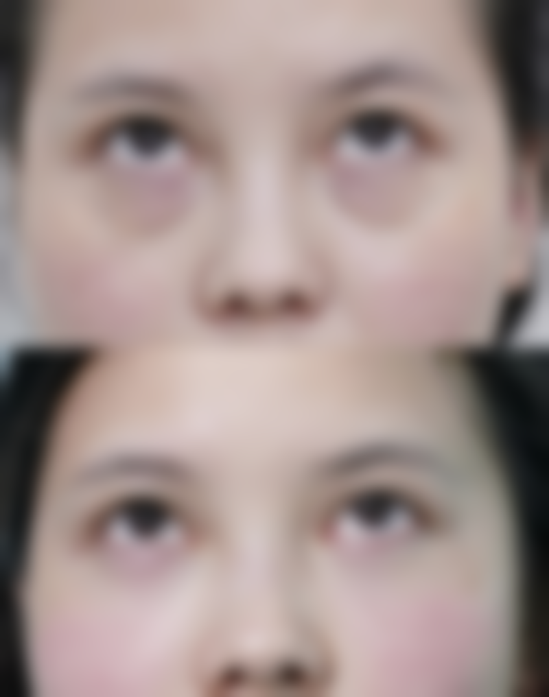 手术后的修复和护理有什么不同?