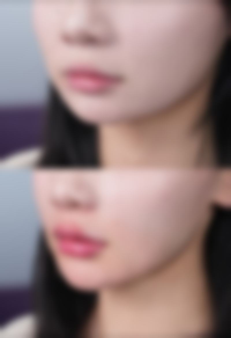 女士发际线和发缝种植的不同阶段成效怎样?